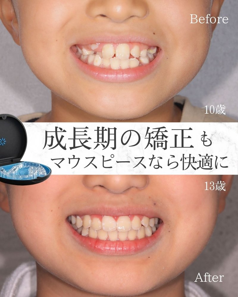 成長期の歯並び矯正の症例