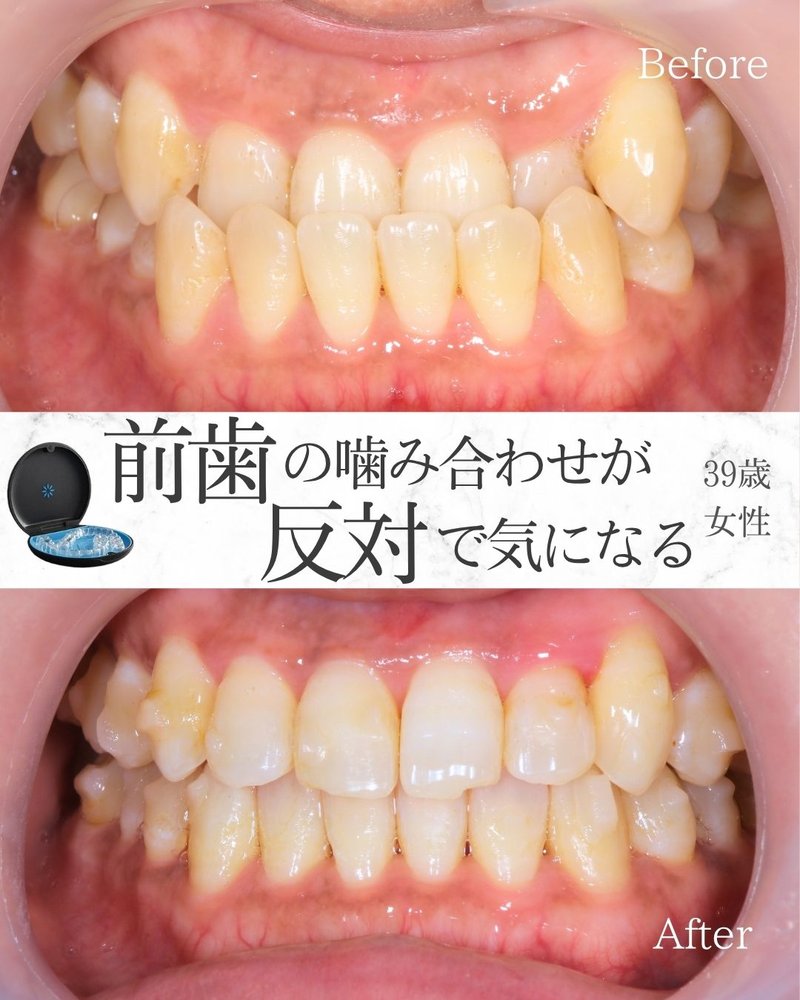 反対咬合の症例