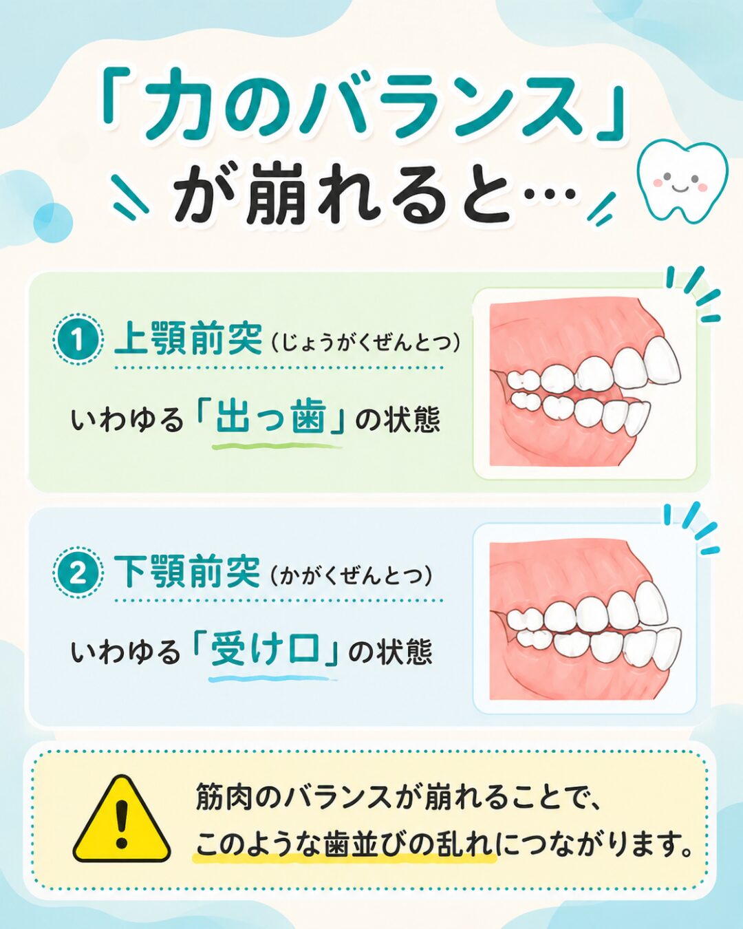 お口まわりの筋肉バランスが崩れると出っ歯や受け口につながる説明