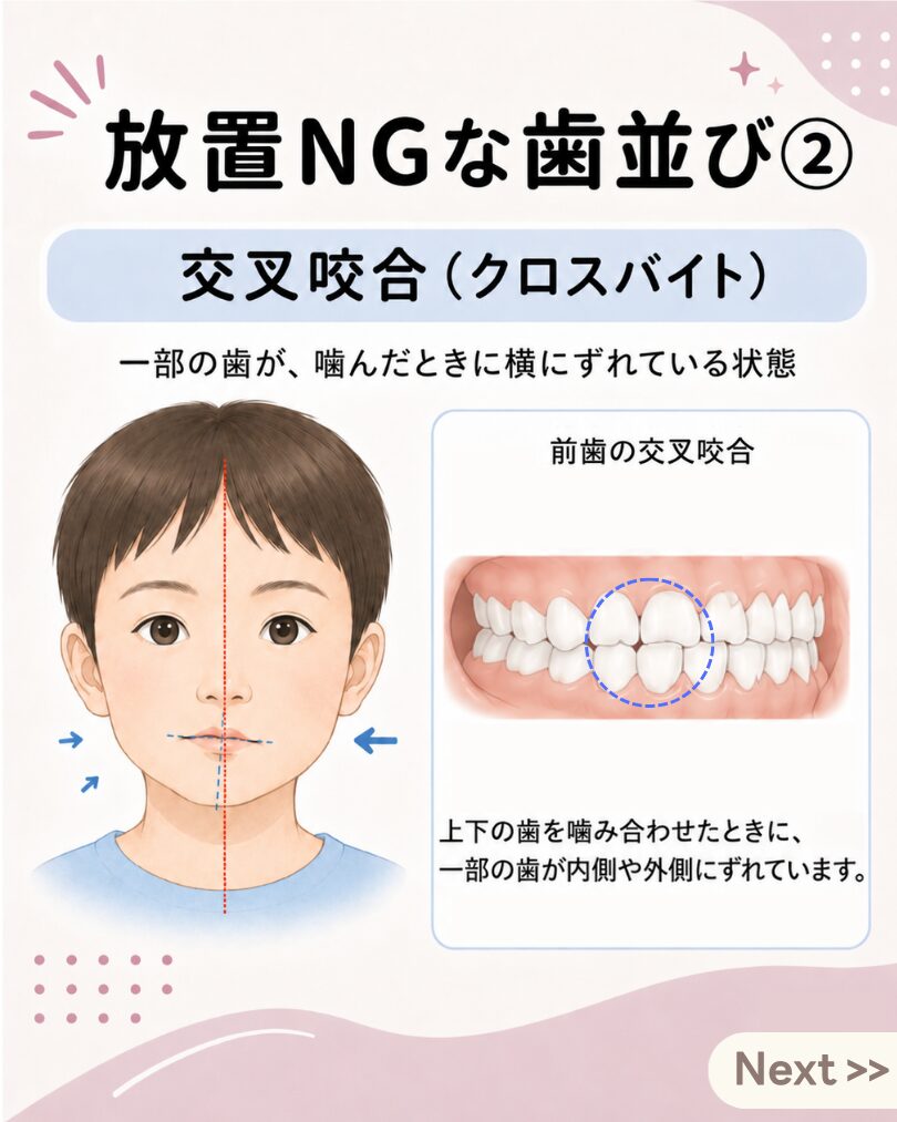 子どもの交叉咬合・クロスバイトの説明