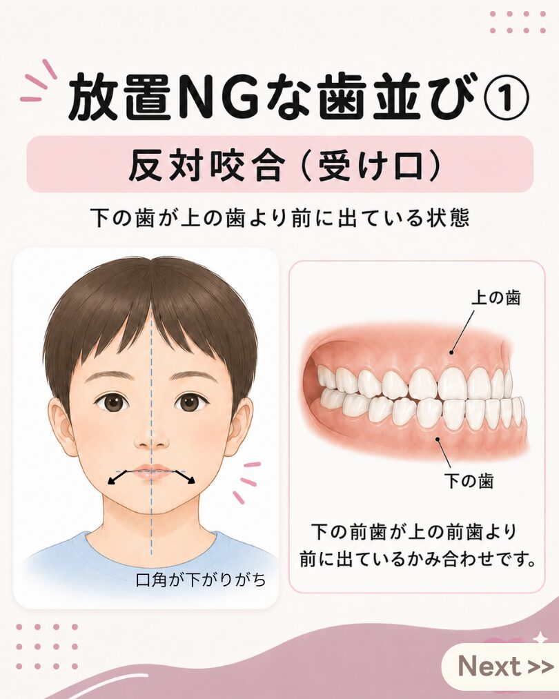 子どもの反対咬合・受け口の説明